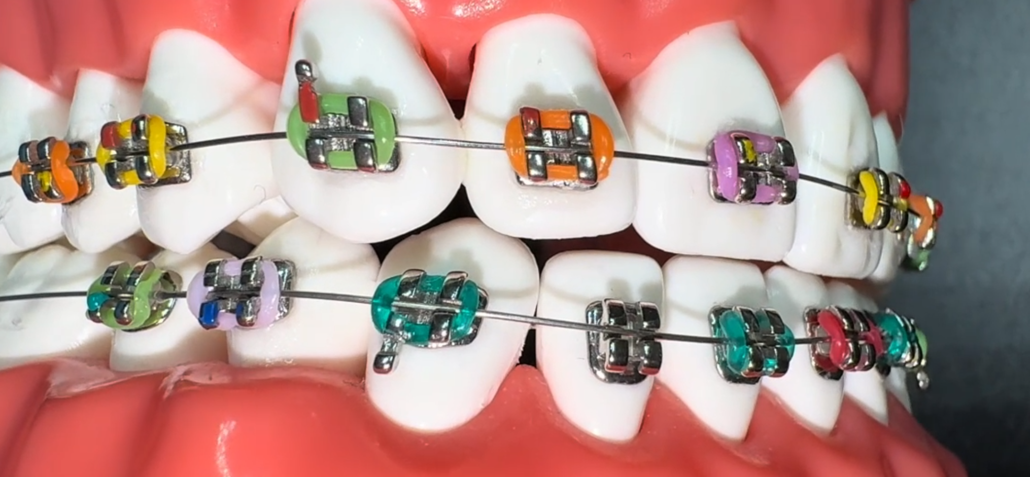 Amazon.com: ARTMAN INSTRUMENTS Dental Braces Color Changing Kit
